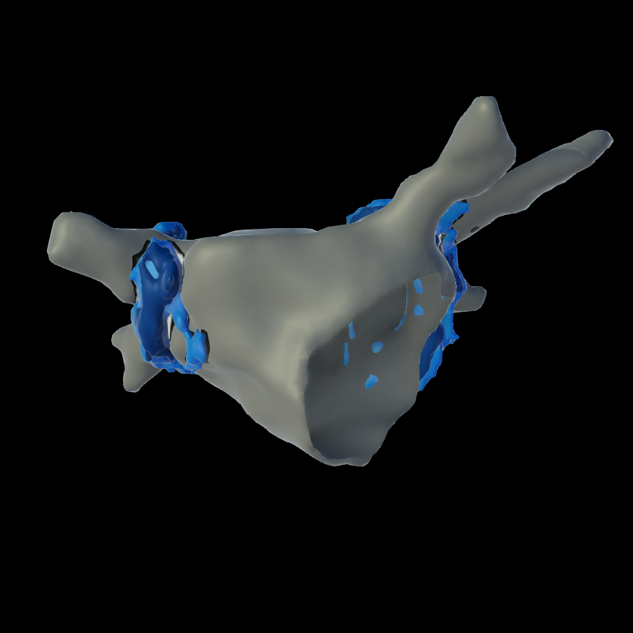 Atrial Fibrillation MR