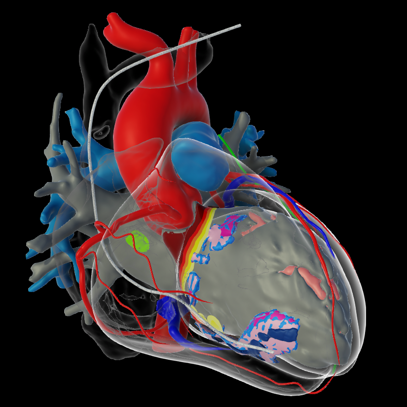 Post myocarditis CT + MR